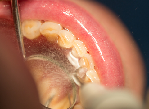 lower teeth being examined with dental tools